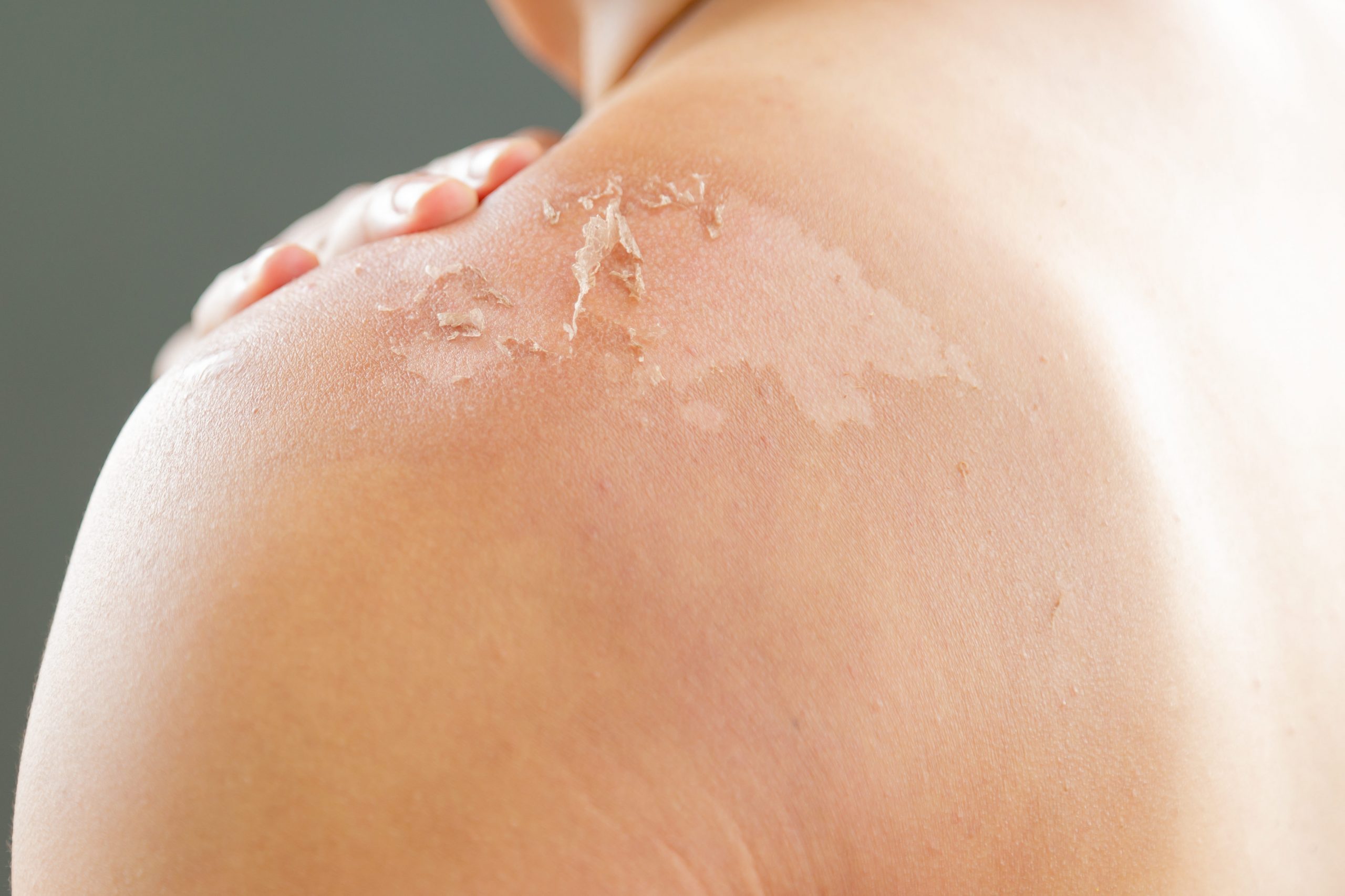 Skin care concept. Handsome guy got sunburn and got tan lines on his back. The skin sloughs off its burn skin. It looks ugly. He has a burning pain on his shoulder. Copy space